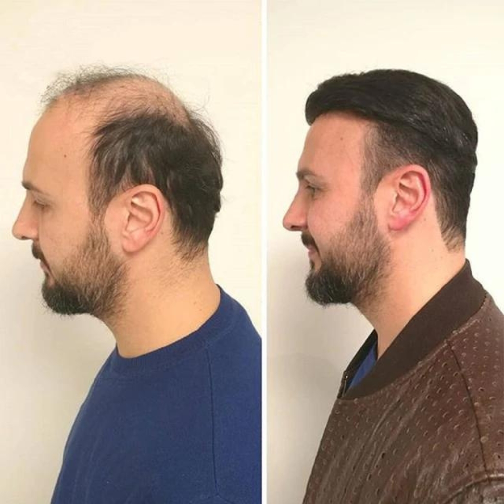 hair patch offer on october